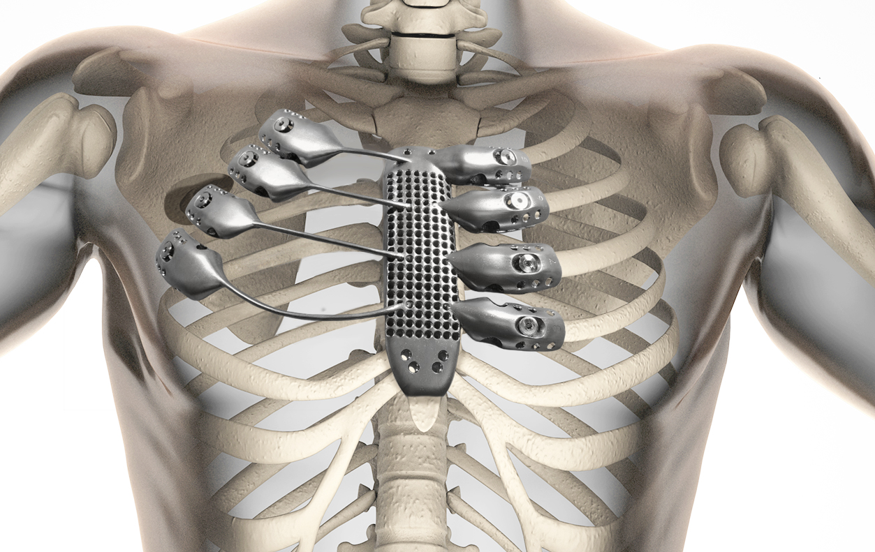 Видео: человеку вживили титановую грудную клетку, напечатанную на 3D-принтере