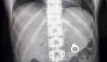 Девушка проглотила кольцо, чтобы пошутить над сестрой. Её ждали врачи, рентген и троллинг в соцсетях