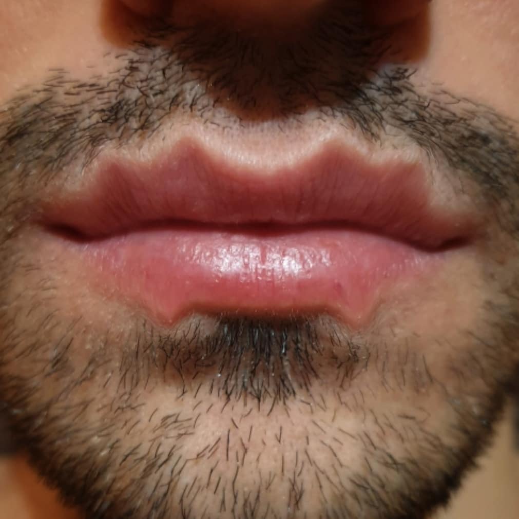 фото порванной губы