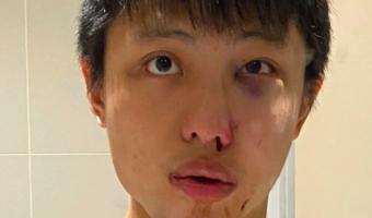 Cтудент из Азии стал жертвой коронавируса, но он здоров. Виноваты глупые стереотипы, от которых нет вакцины
