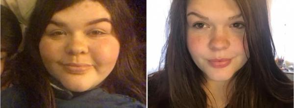 Девушка показала, как изменилось её лицо после похудения. На фото один и тот же человек, но поверить сложно