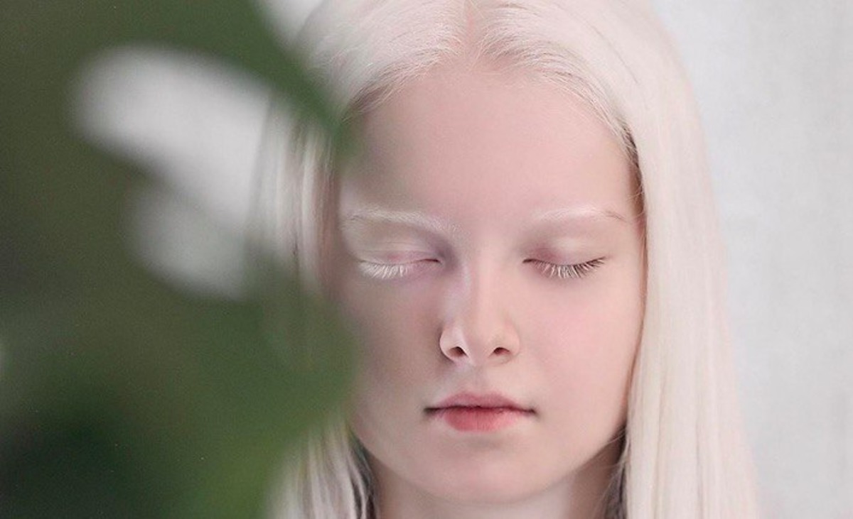 Чеченская девочка-альбинос удивила людей уникальной красотой