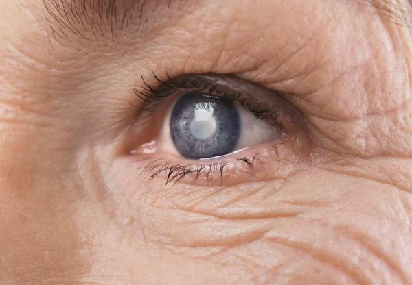 Девушка показала свои глаза после лечения катаракты. В них можно увидеть космос, потому что они сами - звёзды