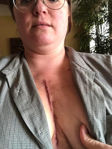 Девушка рассказала о самой страшной операции в своей жизни. От неё остался шрам на груди и запрет на брокколи
