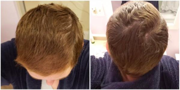 Волосы до и после химиотерапии
