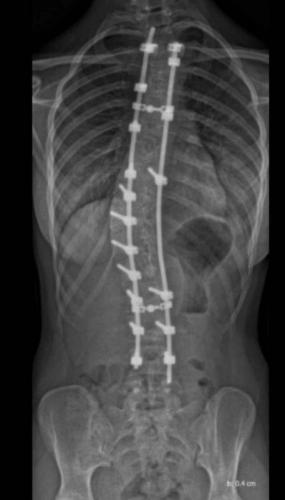 Девушка показала рентген позвоночника после операции. Она почти Терминатор, и вам захочется выпрямить спину