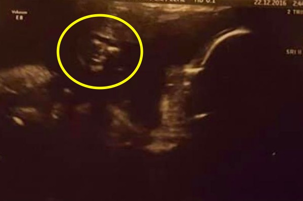 Беременная девушка решила сделать УЗИ и увидела знакомое лицо. Но вряд ли она захочет поставить снимок в рамку