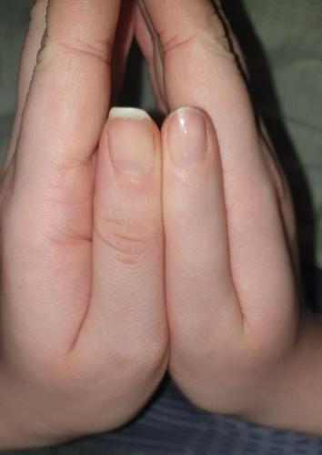 Девушка показала, как выглядит палец , в котором не развился сустав.