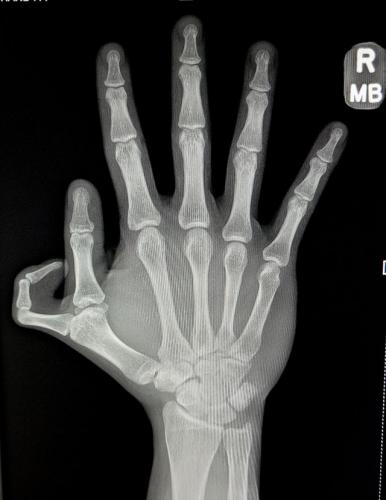 Студент рентген-снимком доказал, что Люди Икс - реальны. Кажется, природа ошиблась, дав людям всего 5 пальцев