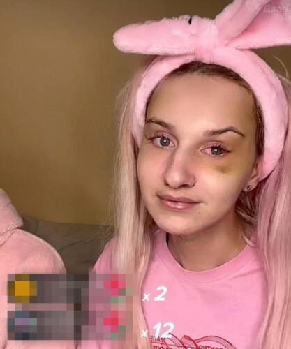 Даша Корейка показала лицо после операции. Подписчики обратили внимание на ассиметрию