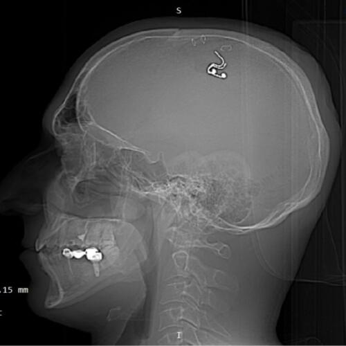 Как Михаил Радуга вставил имплант себе в мозг. Из-за недостатка хирургического опыта чуть не погиб